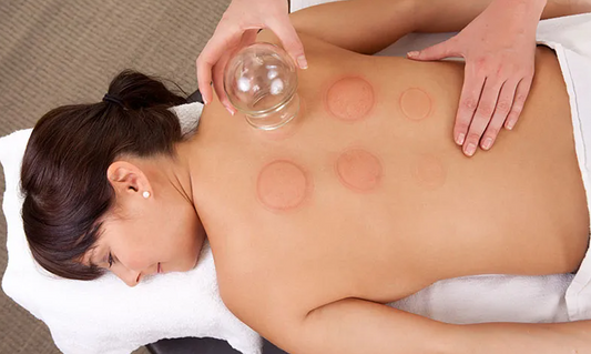 Cupping Treatment